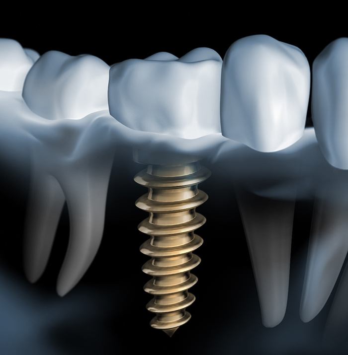 Single Dental Implant Missing Tooth Dr Michael C Byars 